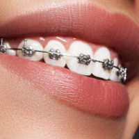 braces